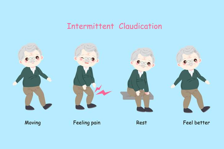 claudicatio: de nieuwe revalidatie